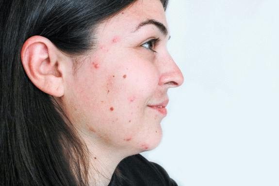 Mandy suffered from Hormonal Acne before getting treatment with ClaraDerma