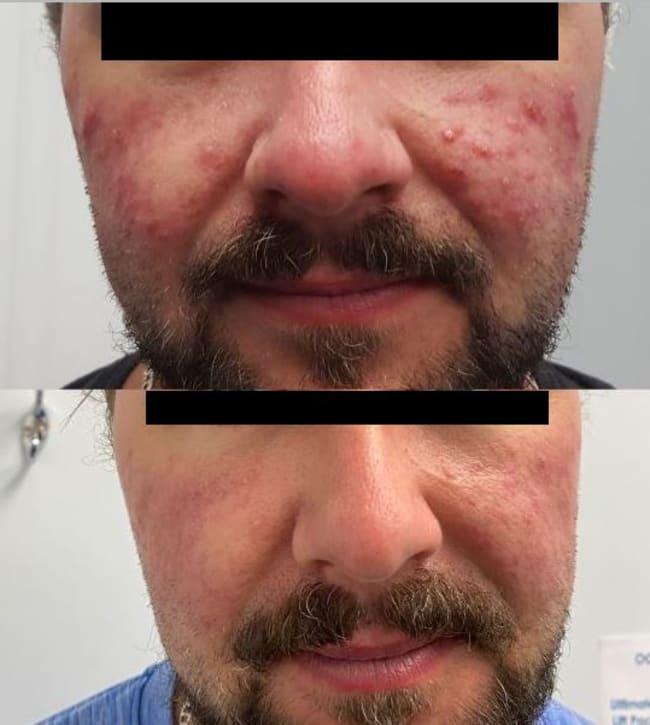 Patient with Rosacea Before Treatment at ClaraDerma