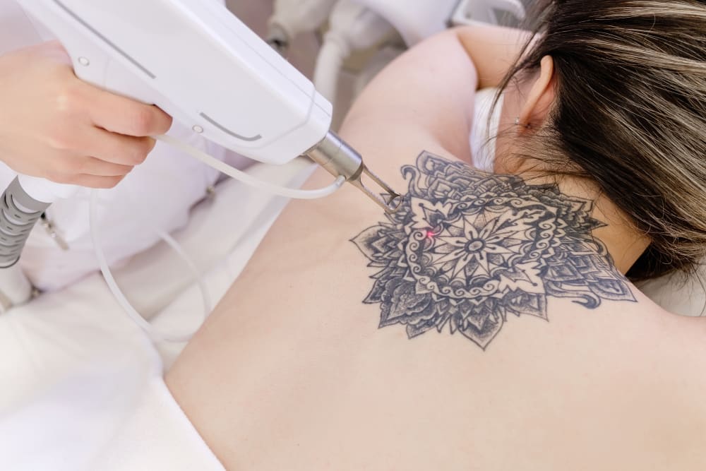 Medical Aesthetician using laser on a young woman's back to remove tattoo with reduced risk of scarring.
